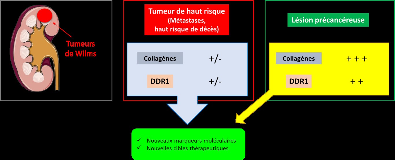 Tumeur_de_Wilms